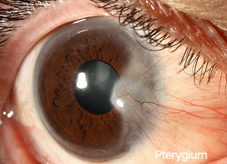 Cataract Surgery - Specializing In Cataract Surgery In Hawaii Kai
