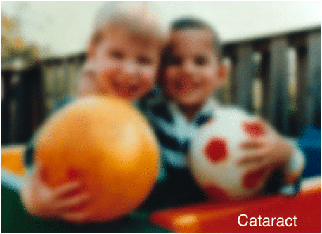 Eye Doctors Hawaii - Glaucoma treatment