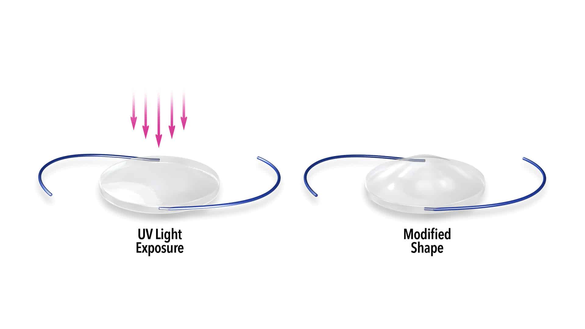 Eye Doctors Hawaii LAL procedure